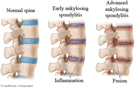 My Ankylosing Spondylitis (AS) in pregnancy was mistaken for PGP